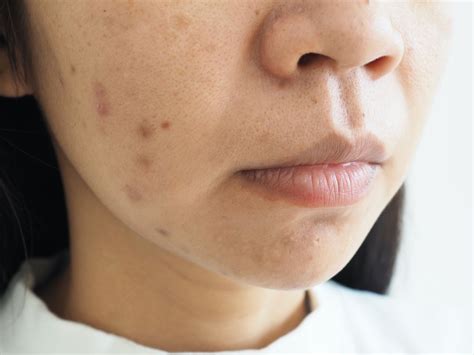 How To Deal With Scars And Post-Inflammatory Hyperpigmentation?